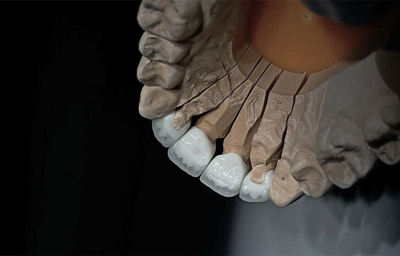 протезирование зубов